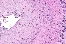 Intermediate magnification micrograph showing giant cell arteritis in a temporal artery biopsy. The arterial lumen is seen on the left. A giant cell is seen on the right at the interface between the thickened intima and media. H&E stain