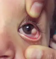 Limbal dermoid as seen in Goldenhar syndrome