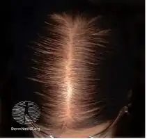 Grade 2 hair loss