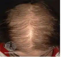 Grade 4 hair loss