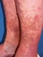 Gravitational dermatitis