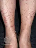 Guttate psoriasis