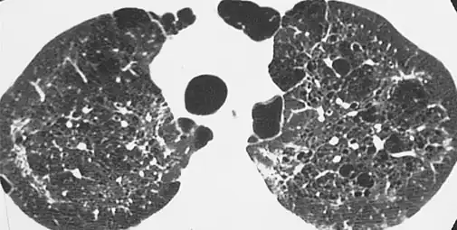 HRCT of cysts of pneumocystis pneumonia. These are usually multiple and bilateral, but range in size, shape and distribution.