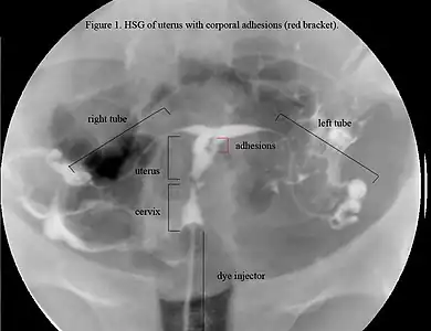 HSG view. Note: not the same uterus as in ultrasound or hysteroscopic view; this uterus appears to be T-shaped.