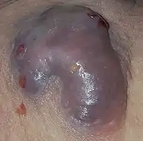 This lesion is about 4 inches across