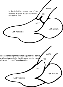 Heart bicuspid aortic valve diagram