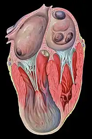 Left ventricular aneurysm