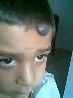 Hemangioma on forehead showing signs of early regression