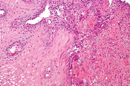 Micrograph of an esophageal biopsy showing herpes eosphagitis, with the characteristic nuclear changes (nuclear moulding, chromatin clumping at the nuclear membrane (margination) and multinucleation). H&E stain.