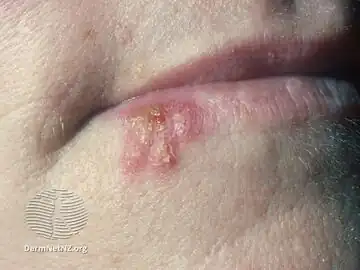 Herpes labialis