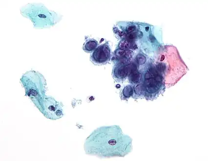 Micrograph of a pap test showing changes (upper right of image) associated with herpes simplex virus, a vertically transmitted infection