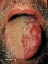 Herpes zoster