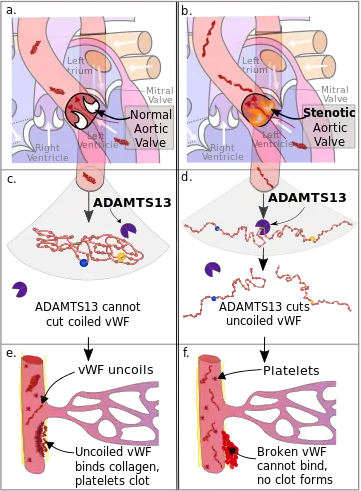 Diagram of the pathophysiology of Heyde's syndrome