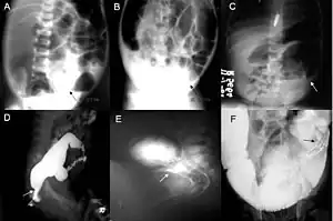 A: Plain abdominal radiograph showing a PARTZ at rectosigmoid, arrow. B: Plain abdominal radiograph showing a PARTZ at midsigmoid, arrow. C: Plain abdominal radiograph showing a PARTZ at descending colon, arrow. D: Contrast enema showing a CETZ at rectosigmoid, arrow. E: Contrast enema showing a CETZ at midsigmoid, arrow. F: Contrast enema showing a CETZ at descending colon, arrow.