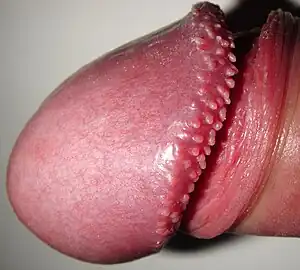 Pearly penile papules