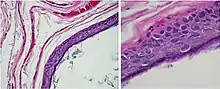 Histopathology, showing a keratinizing stratified squamous epithelium, and a lumen containing keratin flakes