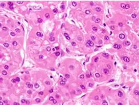 Moderately differentiated HCC.