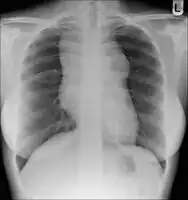 Hodgkin lymphoma