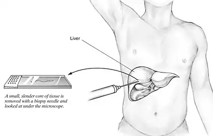 A small quantity of tissue is sampled from the liver when doing a biopsy, which is then examined under a microscope