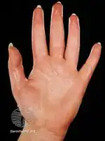 Hyperhidrosis