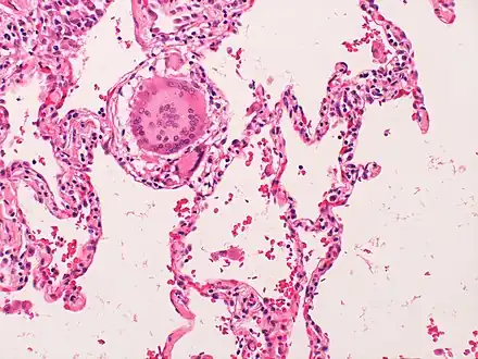 Hypersensitivity Pneumonitis with interstitial multinucleate giant cells