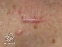 Hypertrophic scar