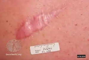 Hypertrophic scar