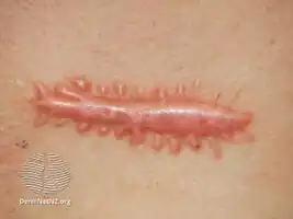 Hypertrophic scar