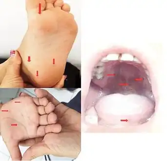 Lesions on  hands and soles of  feet, and blisters in  oral cavity of individual who presented with hand, foot and mouth disease