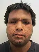 A severe case of facial impetigo.