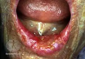 Inner lip cancer