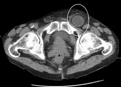 An incarcerated inguinal hernia as seen on cross sectional CT scan