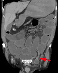 A frontal view of an incarcerated inguinal hernia (on the patient's left side) with dilated loops of bowel above.