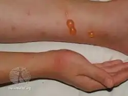 Insect bite