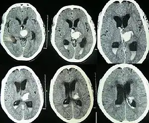 Spontaneous ICH with hydrocephalus on CT scan