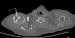 Axial CT with left humeral head EZ IO infusion of contrast.