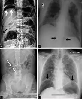 a) X-ray of abdomen, showing subdiaphragmatic free air, air outlining the properitoneal fat stripe black arrows b) Cupola sign arrowheads  c) Rigler's sign d) chest radiograph showing free air under the diaphragms