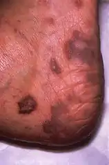 Kaposis Sarcoma