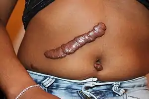 Keloid scar