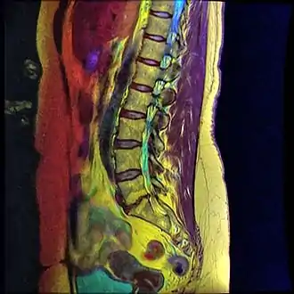 Retrolisthesis of L5-S1