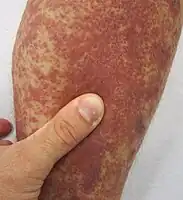 Leukocytoclastic vasculitis