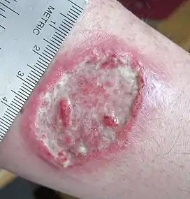 Cutaneous leishmaniasis ulcer