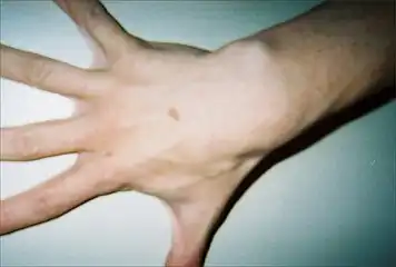 Hand of 37-year-old patient showing interdigital webbing