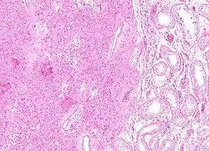 Low magnification micrograph of a Leydig cell tumour. H&E stain.