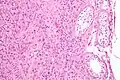 Intermediate magnification micrograph of a Leydig cell tumour. H&E stain.