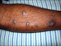 Lichen planus