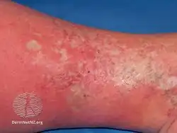 Livedoid vasculitis