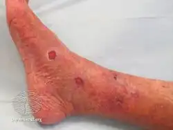 Livedoid vasculitis