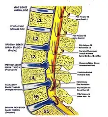 Lumbar disc lesions, classification