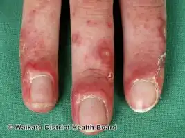 Lupus chilblains